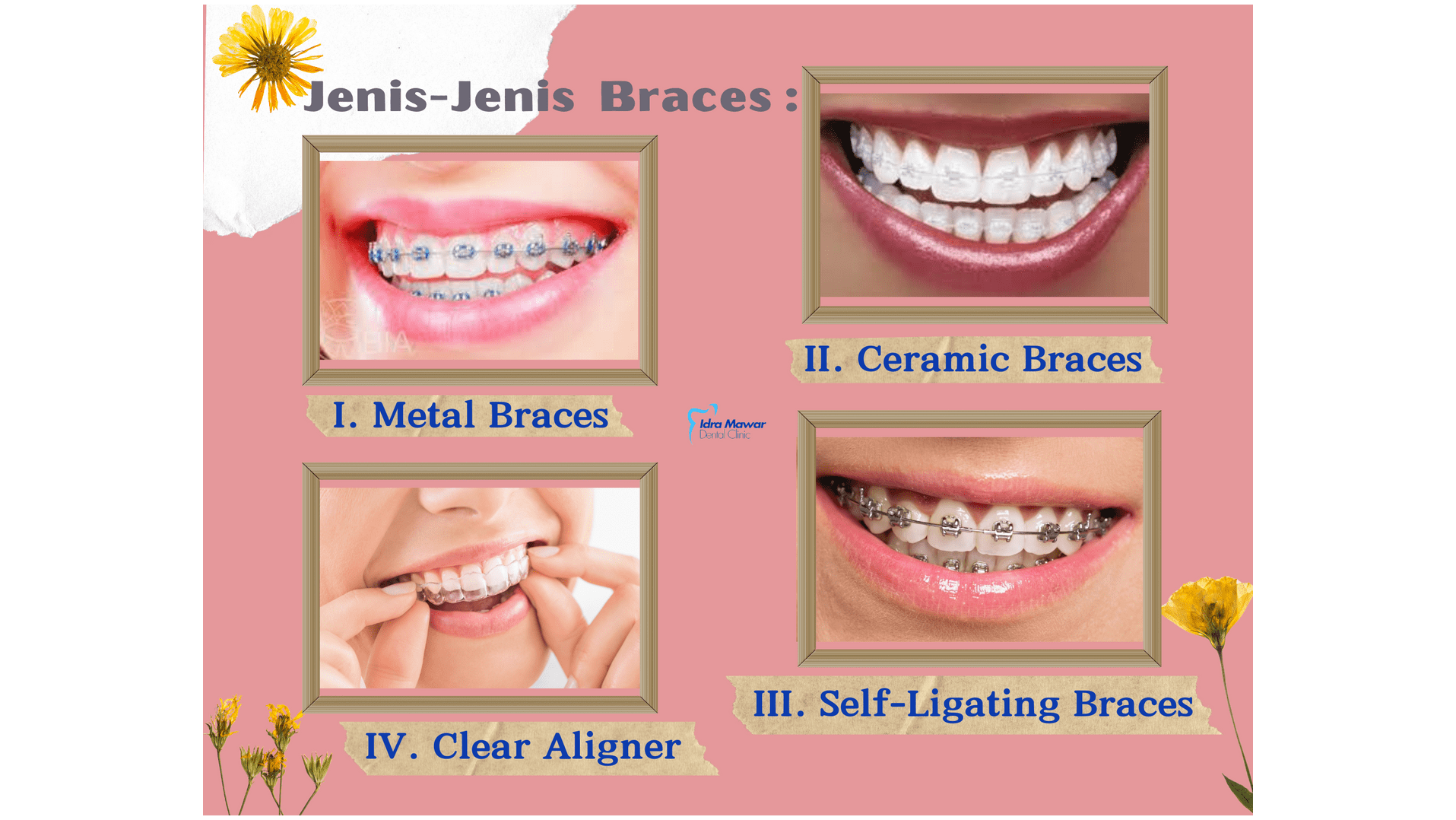 tips after bonding in braces tips after bonding in braces