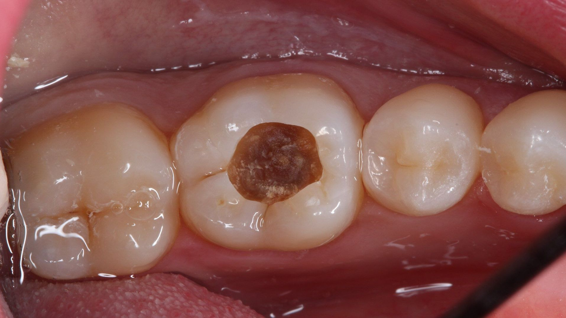 A decayed tooth has damage caused by bacteria, leading to cavities and possible pain or sensitivity.