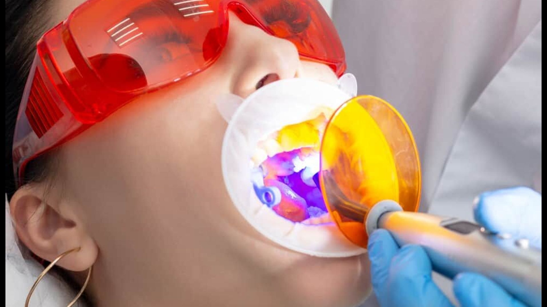 A tooth filling restores tooth function and prevents further decay, protecting the tooth long-term when properly cared for.