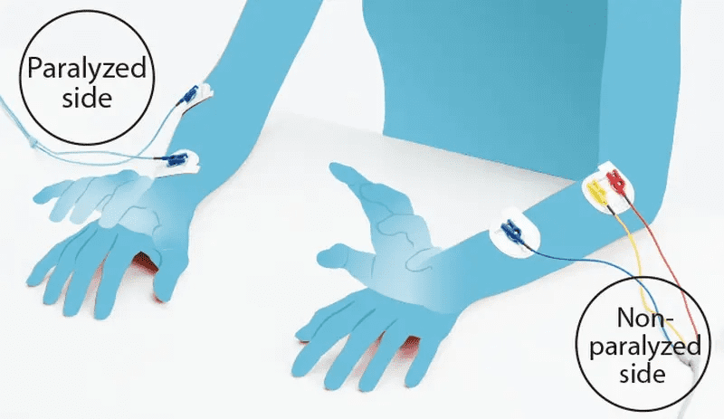FES IVES™ technology for adaptive stimulation
