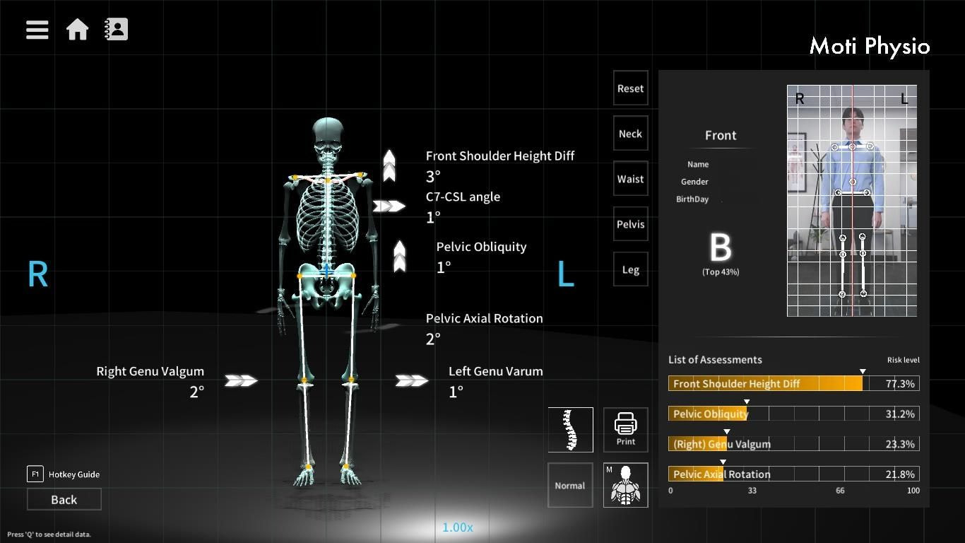 Moti Physio postural analysis
