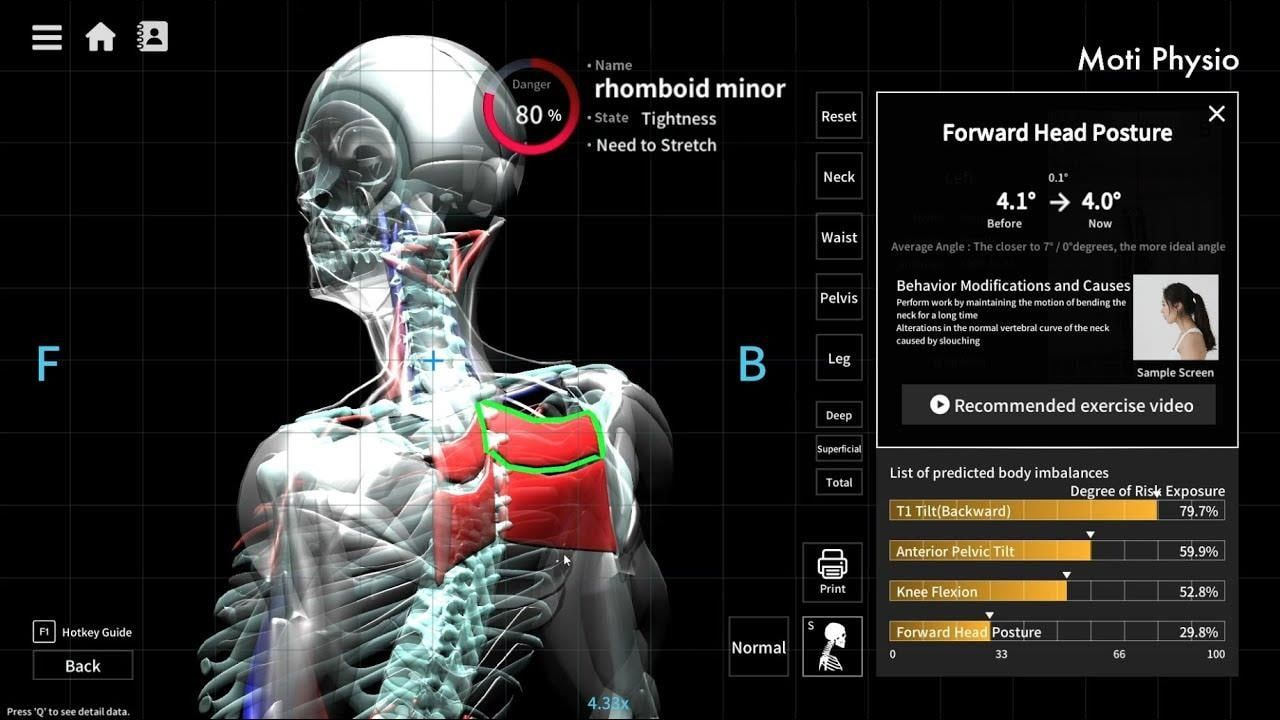 Moti Physio postural analysis
