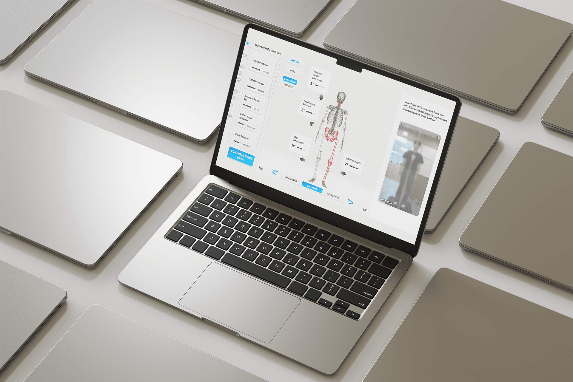 Moti Physio software interface on a laptop