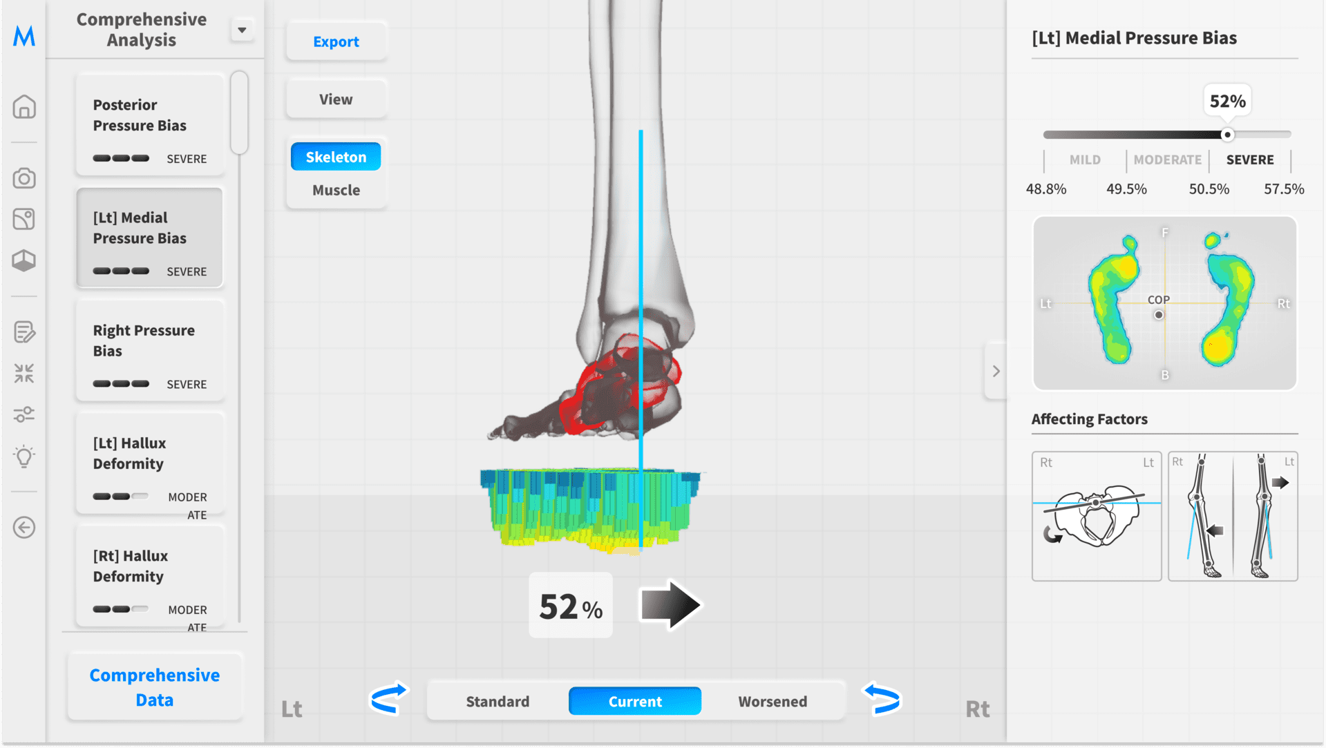 Foot Insight – medial pressure of the left foot 52%