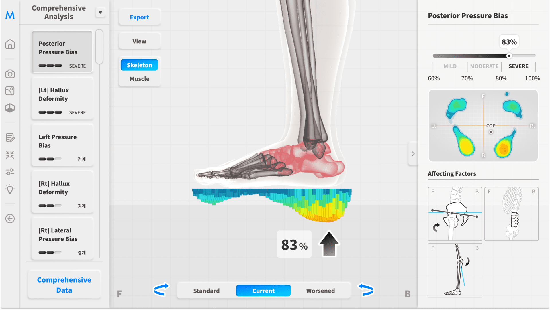 Foot Insight – posterior foot pressure 83%