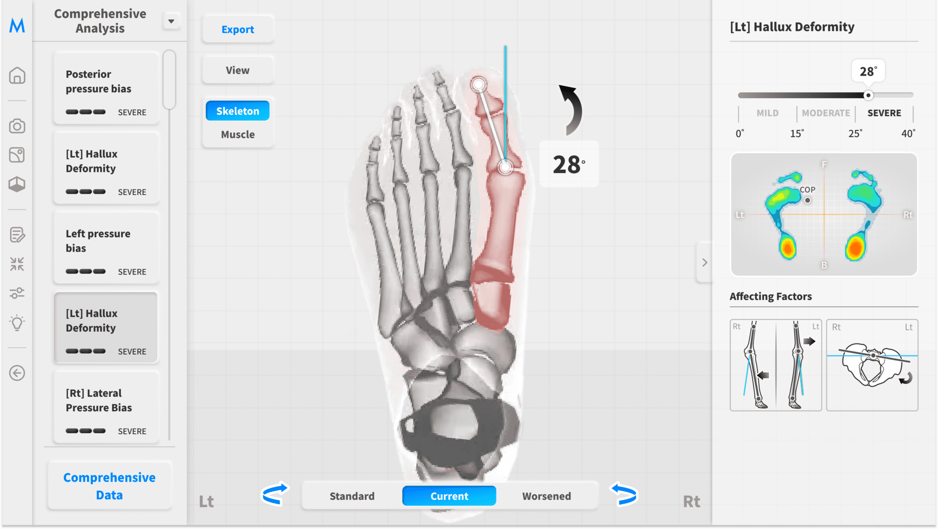 Foot Insight – hallux valgus, angle 28°